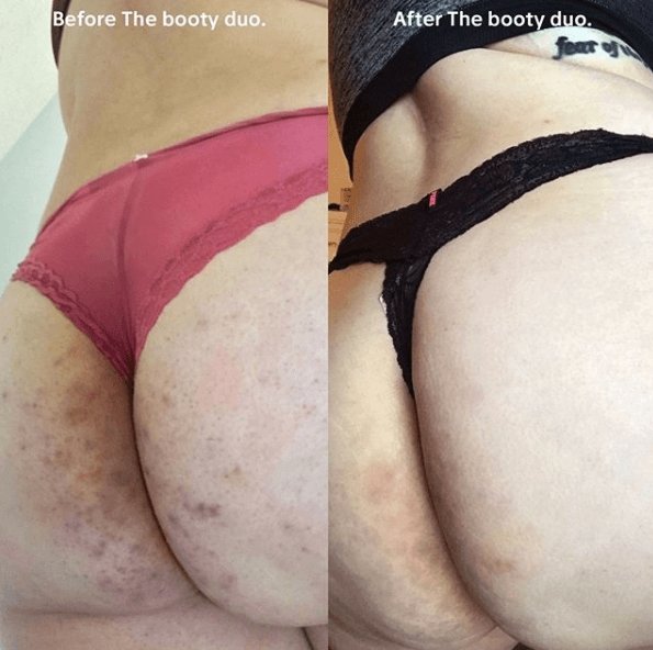 Sara's booty routine for stretch marks and acne - Anese