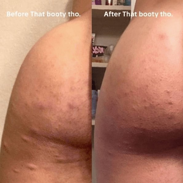 The Booty Duo vs. Acne - Anese