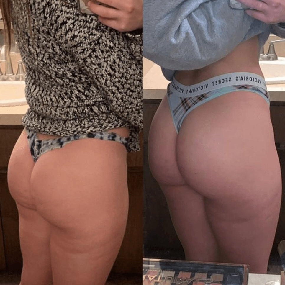 Isabel's cellulite results after one jar - Anese