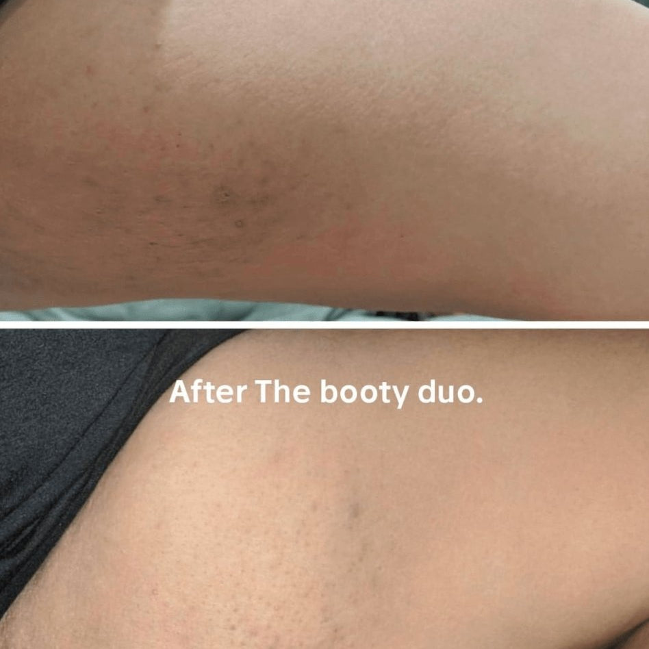 Carolina's booty duo routing for discoloration, chafing and acne. - Anese