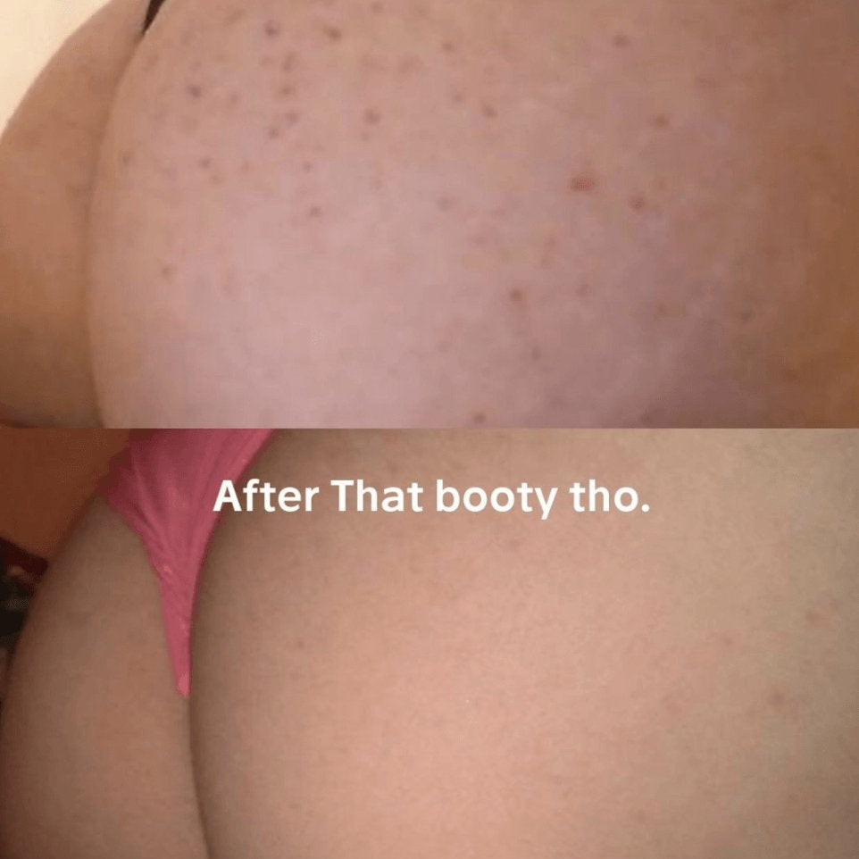 Reduction in acne using That Booty Tho - Anese