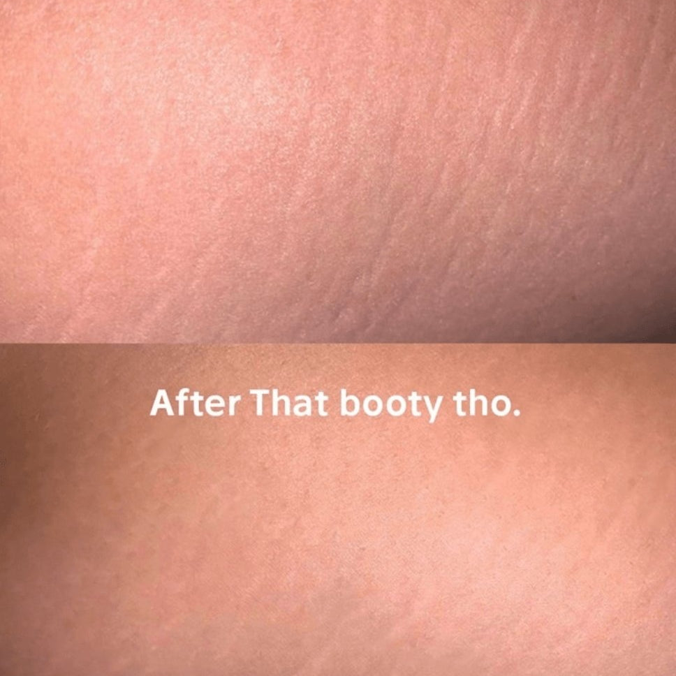 A visible reduction in stretch marks with That Booty Tho - Anese