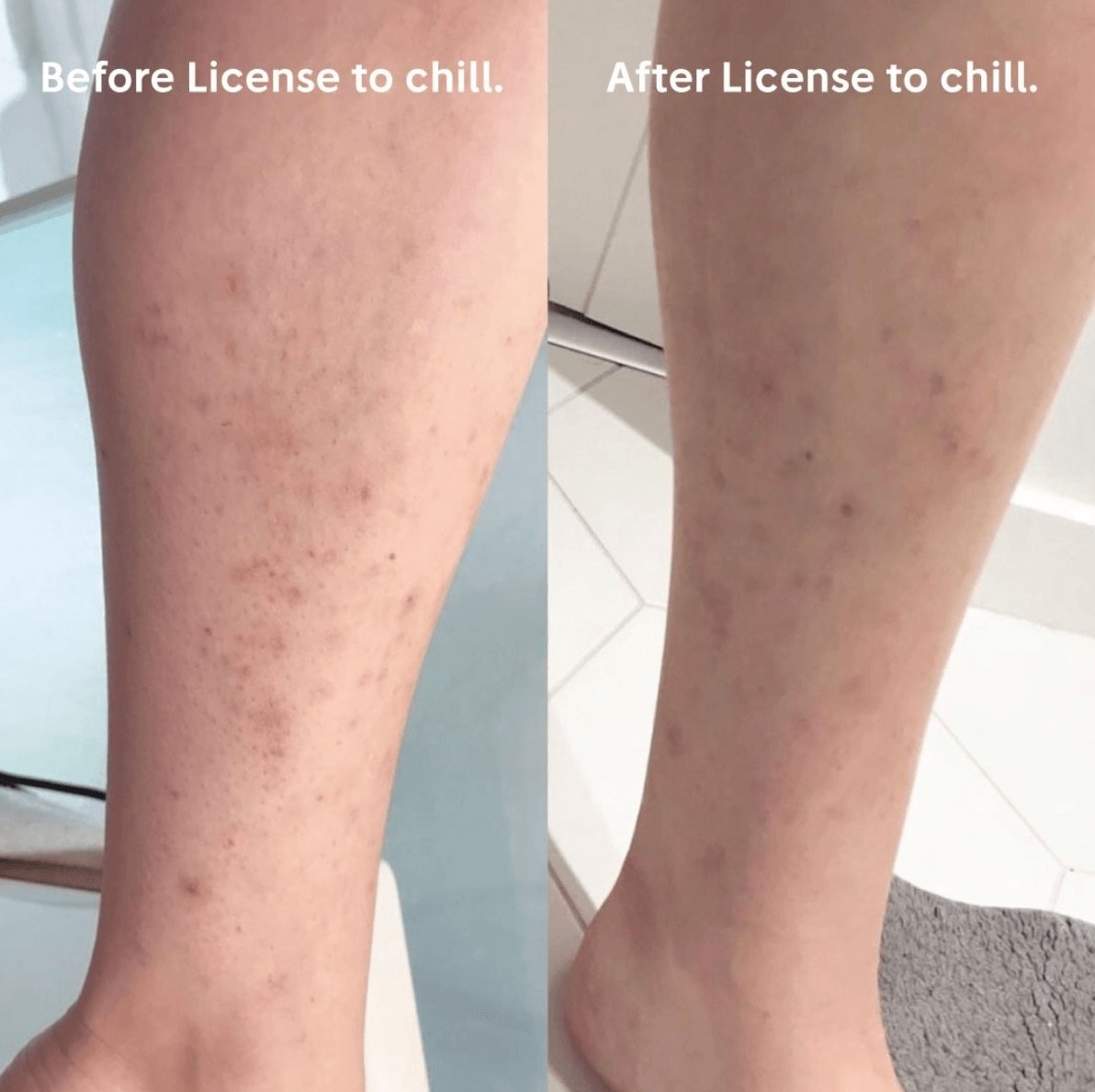 Gabriela reduced body acne with License to chill - Anese