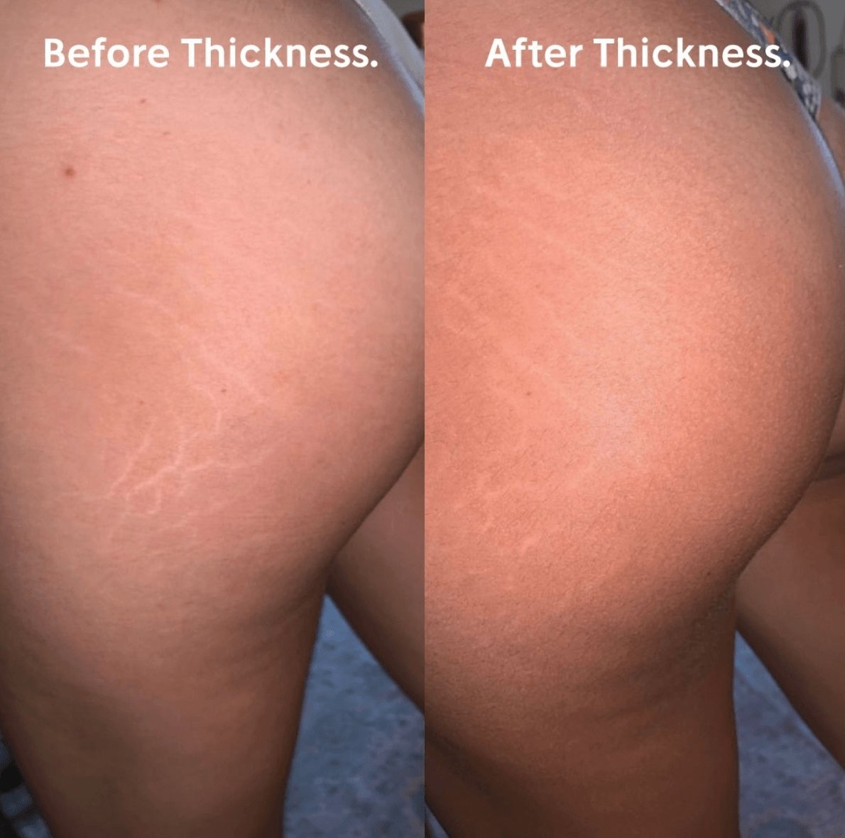 Olivia used Down with the thickness to reduce stretch marks and acne - Anese