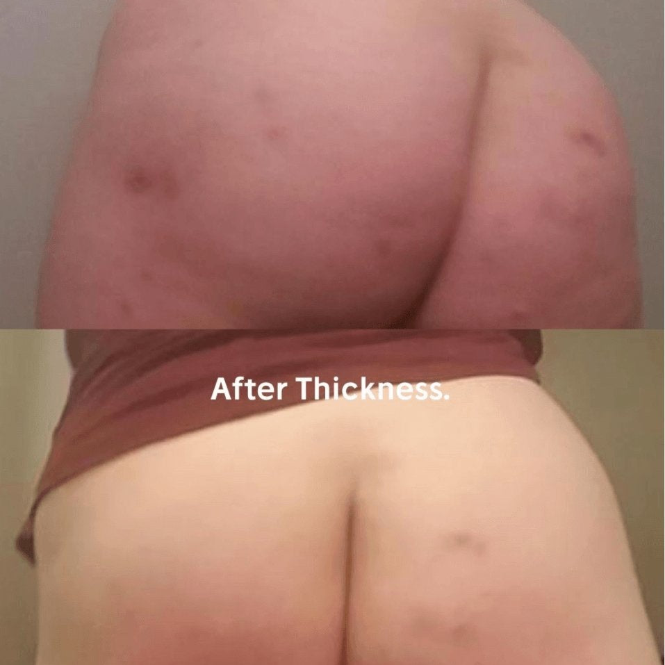 Cassandra diminished her scars with Down with the thickness! - Anese