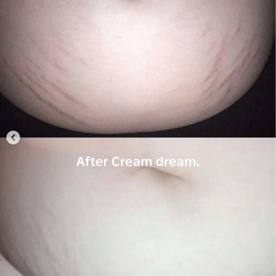 Cream Dream's Visible Results! - Anese
