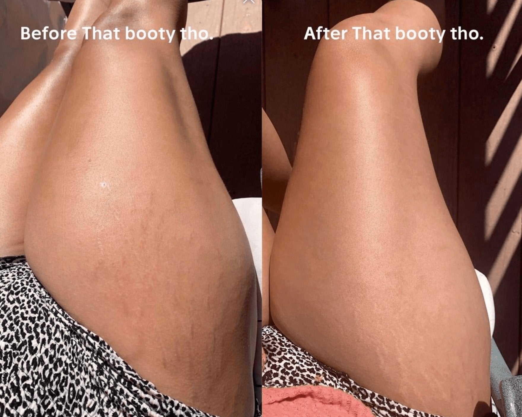 Major Difference in Thigh Stretch Marks - Anese