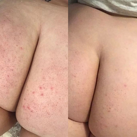 Folliculitis